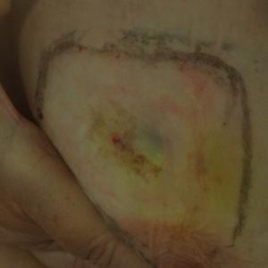 Biopsy: Humiliation and pain