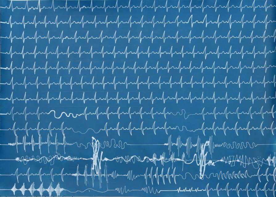 Medical data drawing-heart-rhythm